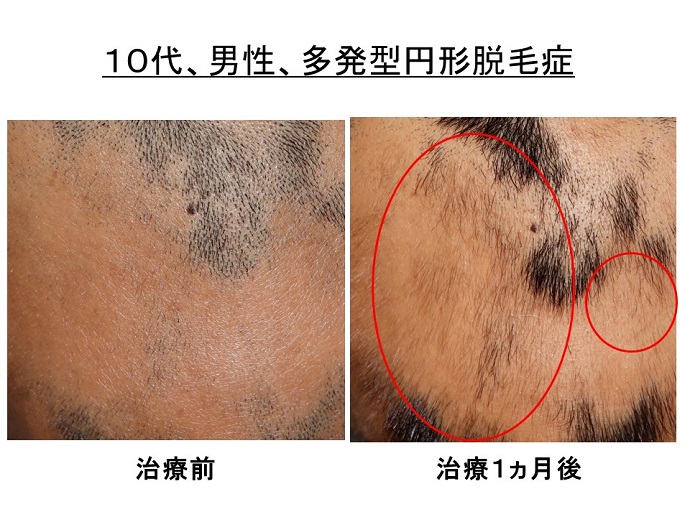 円形脱毛症　病院